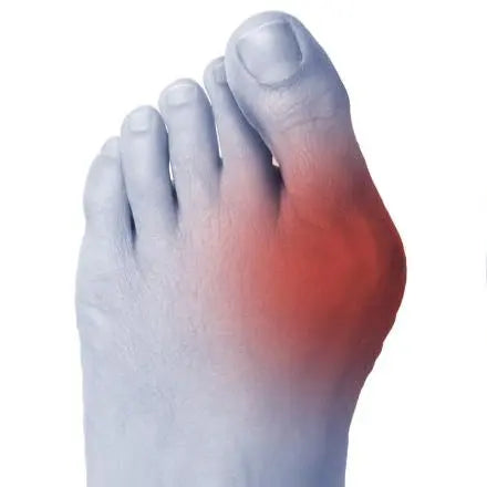 Orthèse Hallux